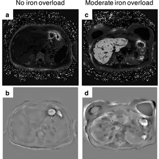 Iron Estimation in Liver